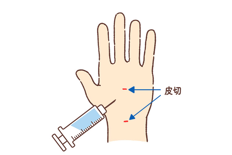 当院での鏡視下手根管開放術のイメージ