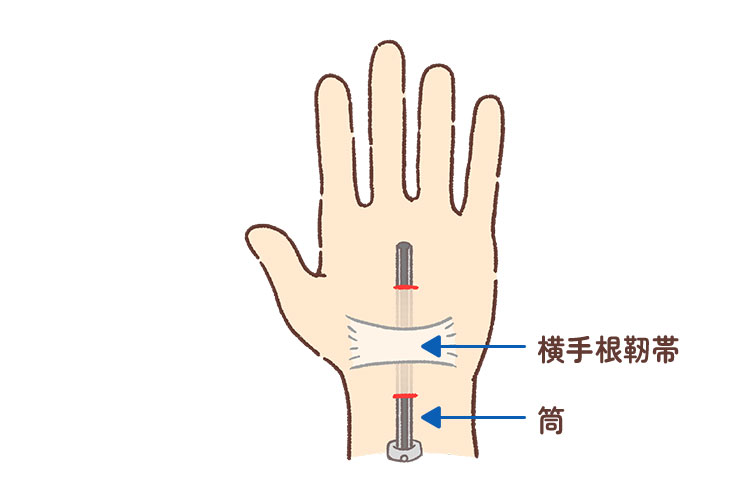 当院での鏡視下手根管開放術のイメージ