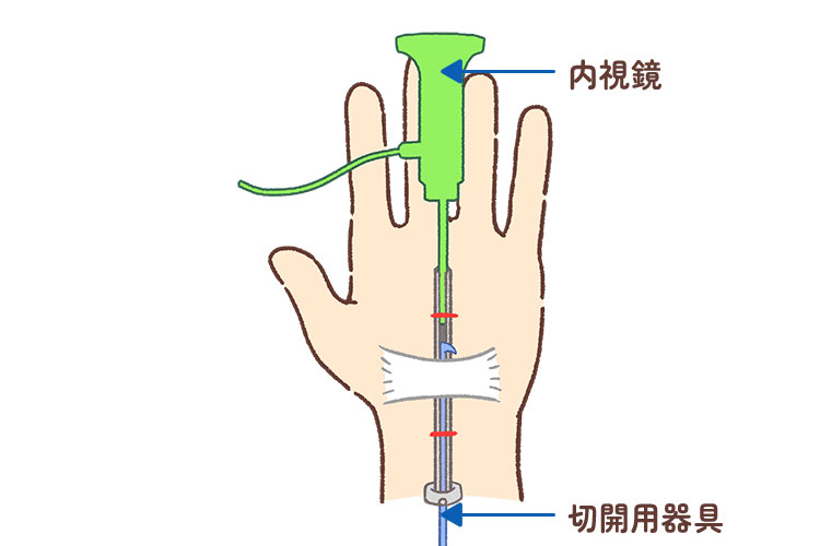 当院での鏡視下手根管開放術のイメージ