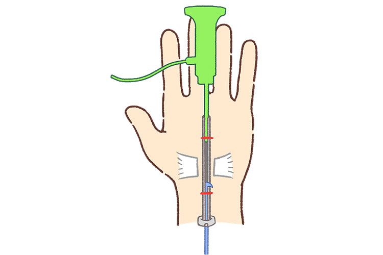当院での鏡視下手根管開放術のイメージ