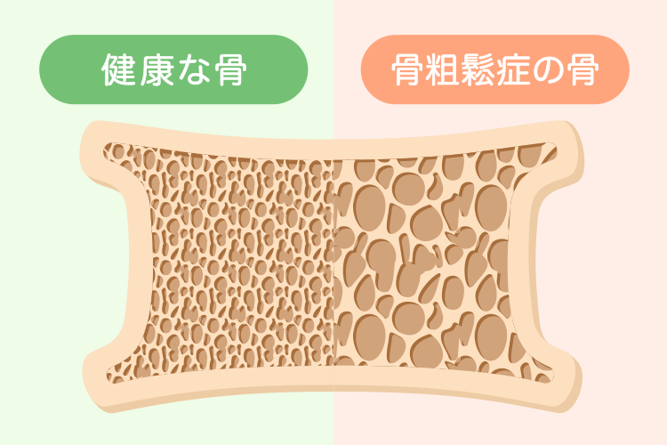 骨粗鬆症イメージ