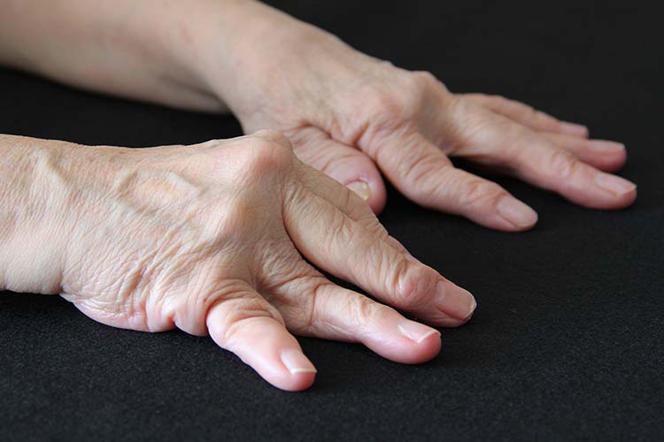 リウマチイメージ